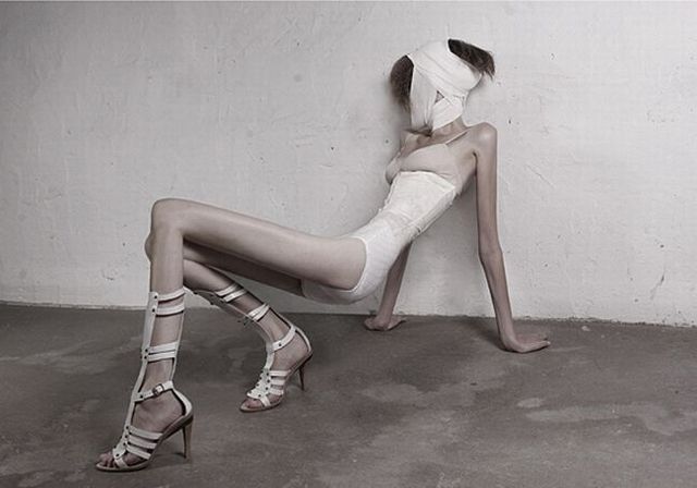 Anorexia – it’s terrifying! (14 pics)