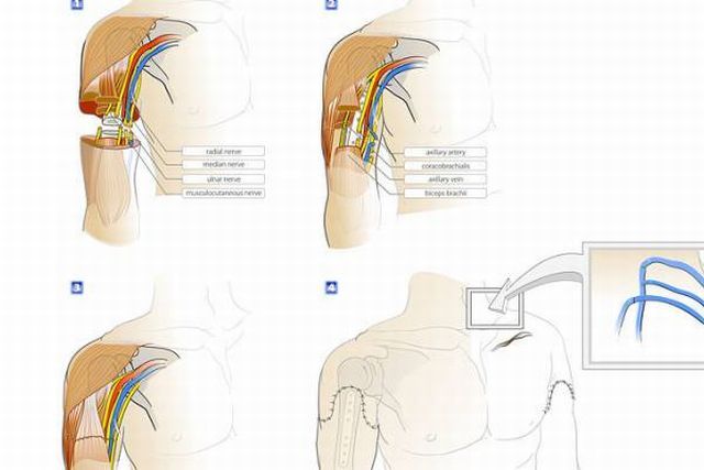 Dünyadaki ilk tam çift kol nakli