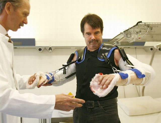 Dünyadaki ilk tam çift kol nakli