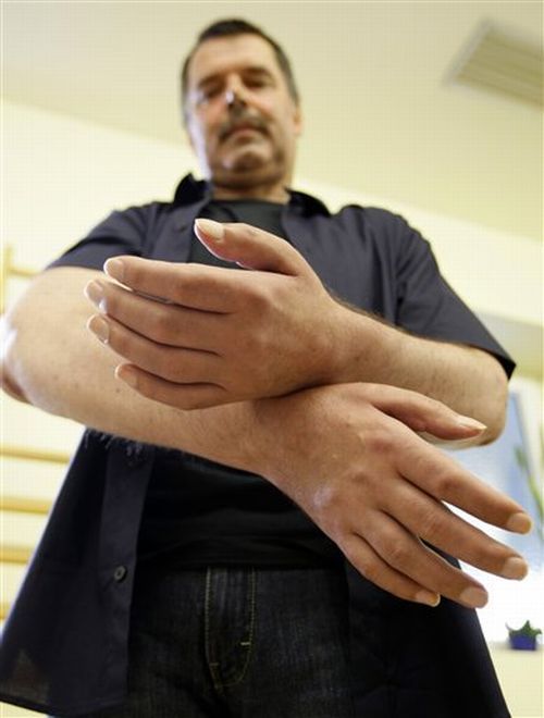 Dünyadaki ilk tam çift kol nakli