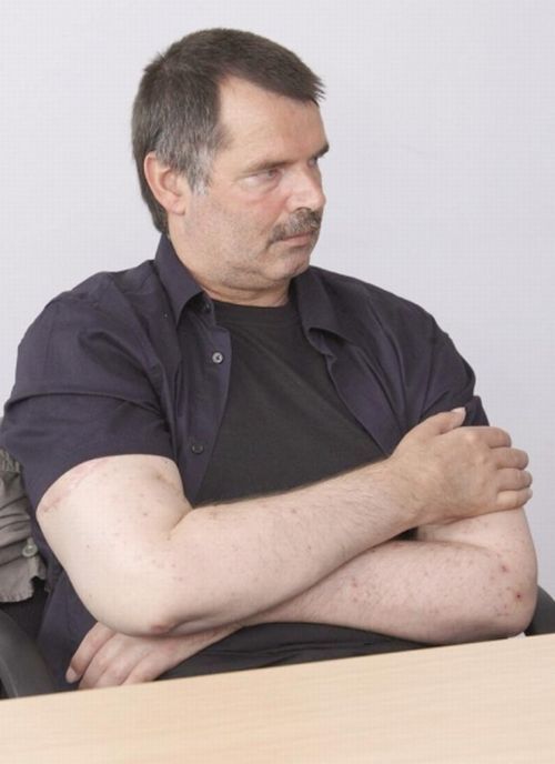 Dünyadaki ilk tam çift kol nakli