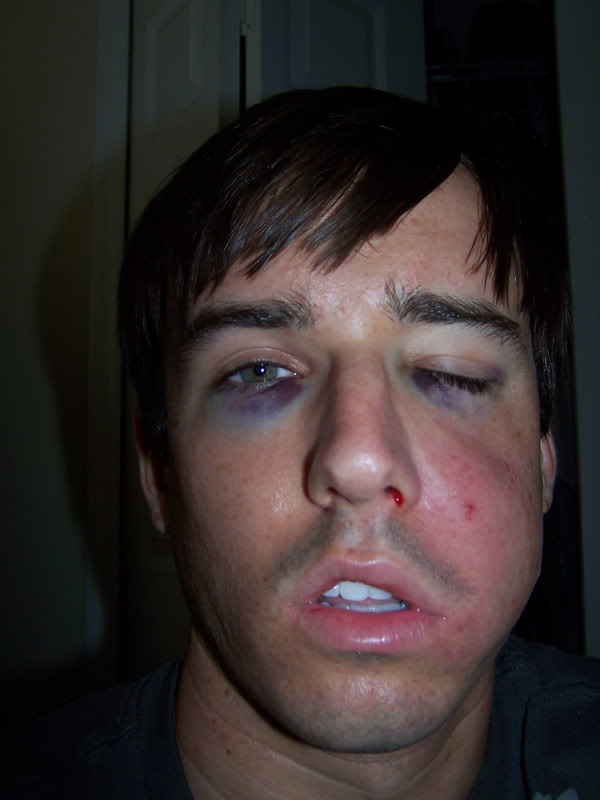 Baseball Hits Face at 100 mph (14 pics)