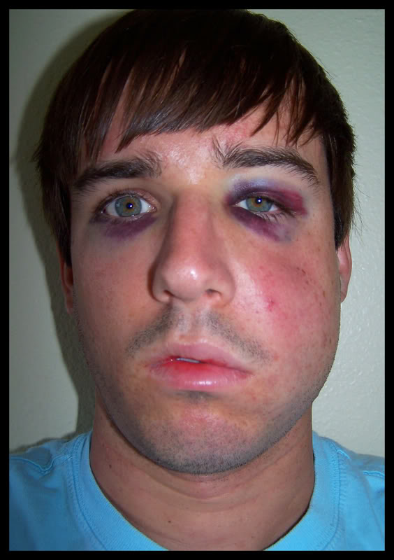 Baseball Hits Face at 100 mph (14 pics)