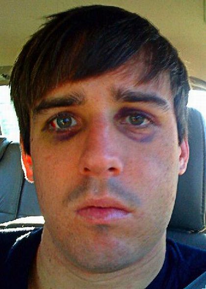 Baseball Hits Face at 100 mph (14 pics)