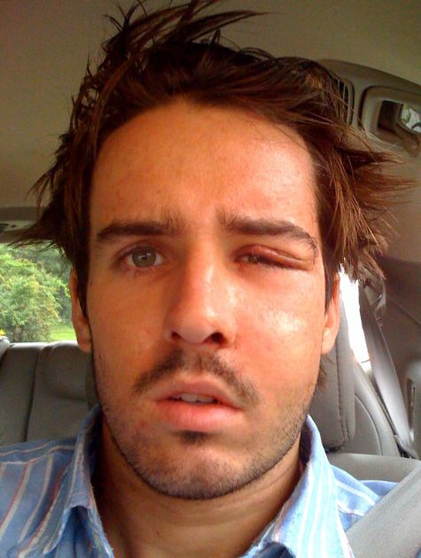 Baseball Hits Face at 100 mph (14 pics)