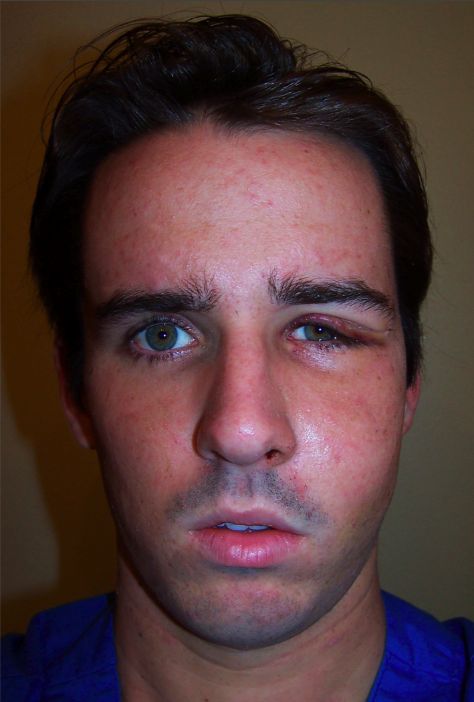 Baseball Hits Face at 100 mph (14 pics)