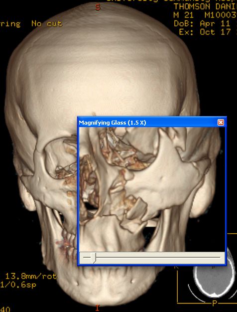 Baseball Hits Face at 100 mph (14 pics)