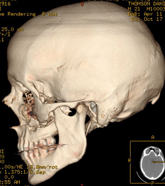 Baseball Hits Face at 100 mph (14 pics)