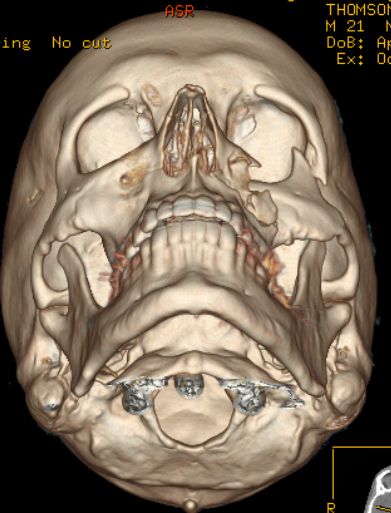 Baseball Hits Face at 100 mph (14 pics)