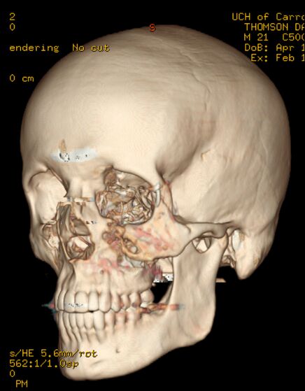 Baseball Hits Face at 100 mph (14 pics)