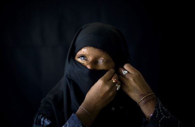 OMG of the Day. â€œAcid Terrorismâ€� Against Women in Pakistan (12 pics + text)