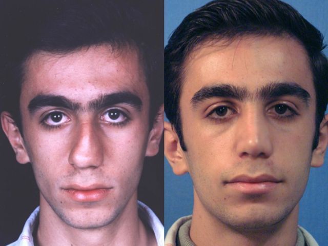Before and After a Nose Job (24 pics)