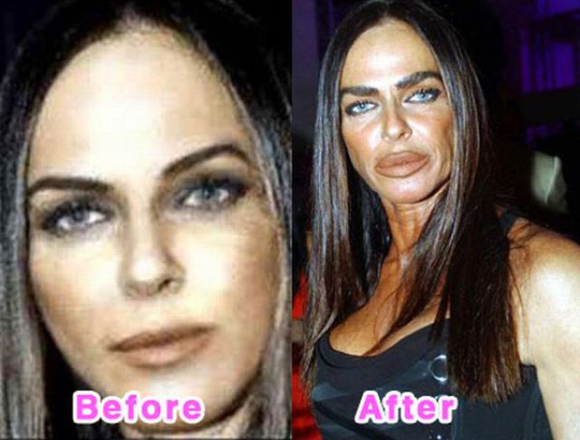 Bruce Jenner Plastic Surgery Photos. Bruce Jenner Plastic Surgery: